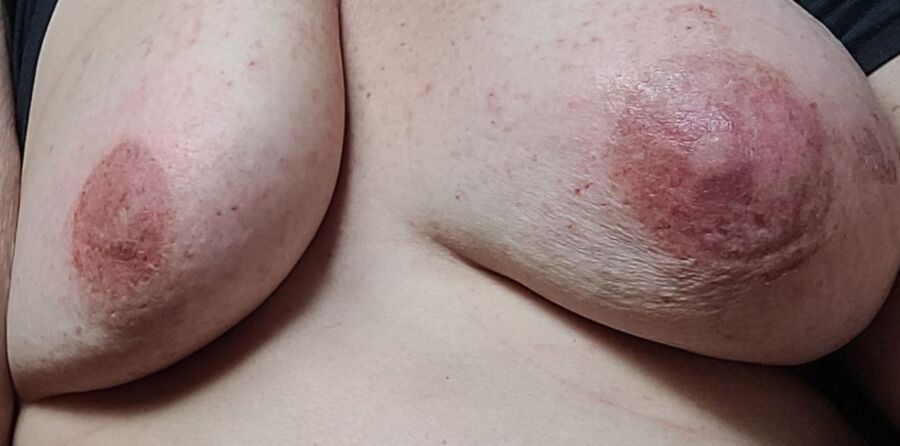 Fatpig sore nipples