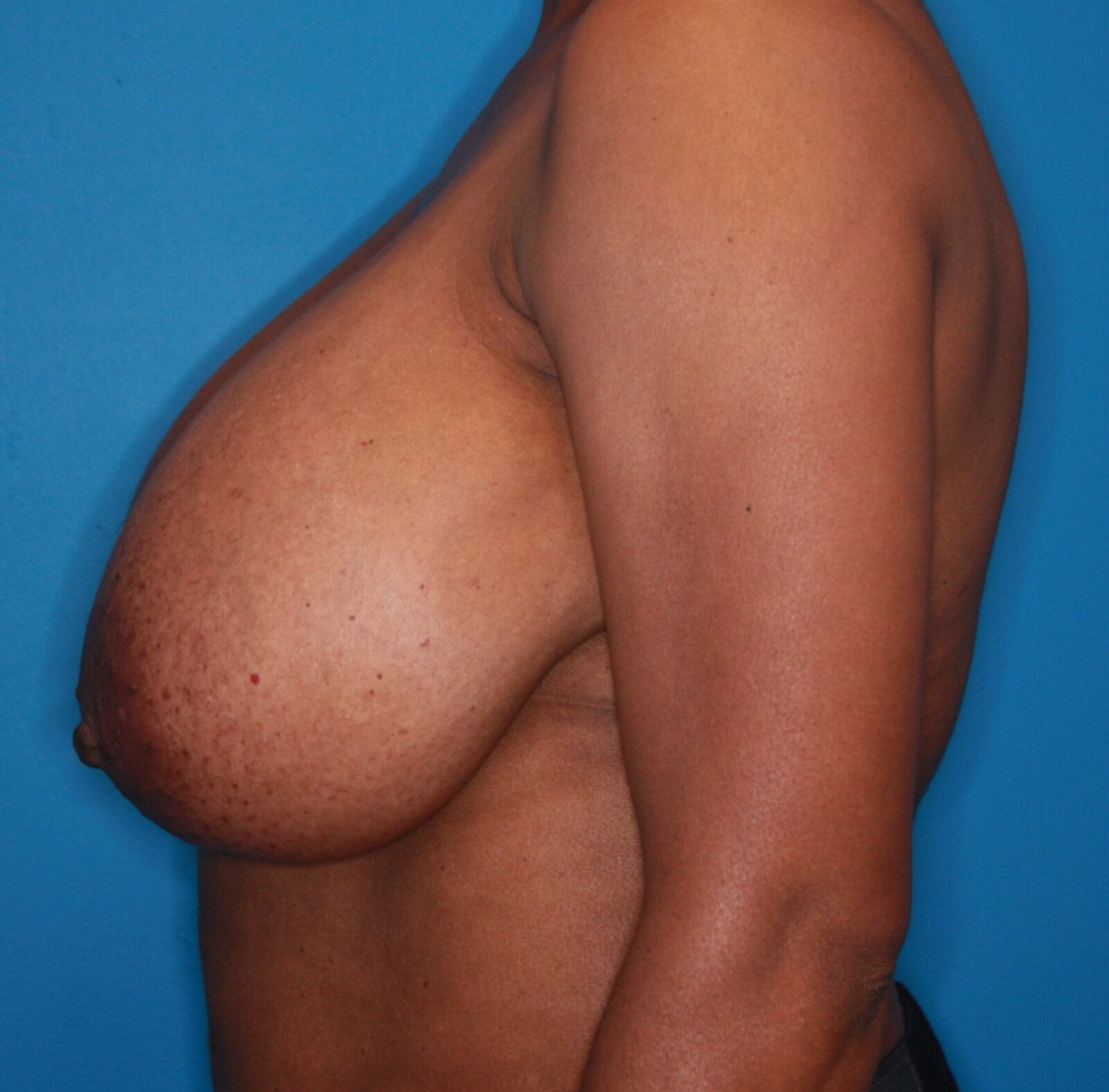 Pre Op Breast Reduction Collection 11