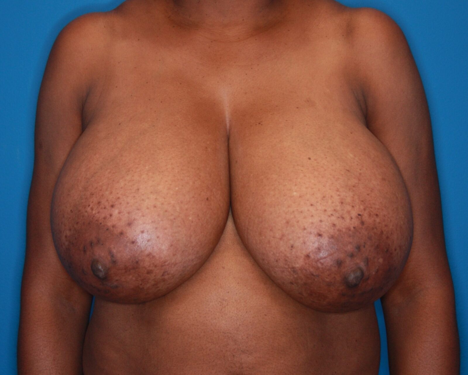 Pre Op Breast Reduction Collection 11