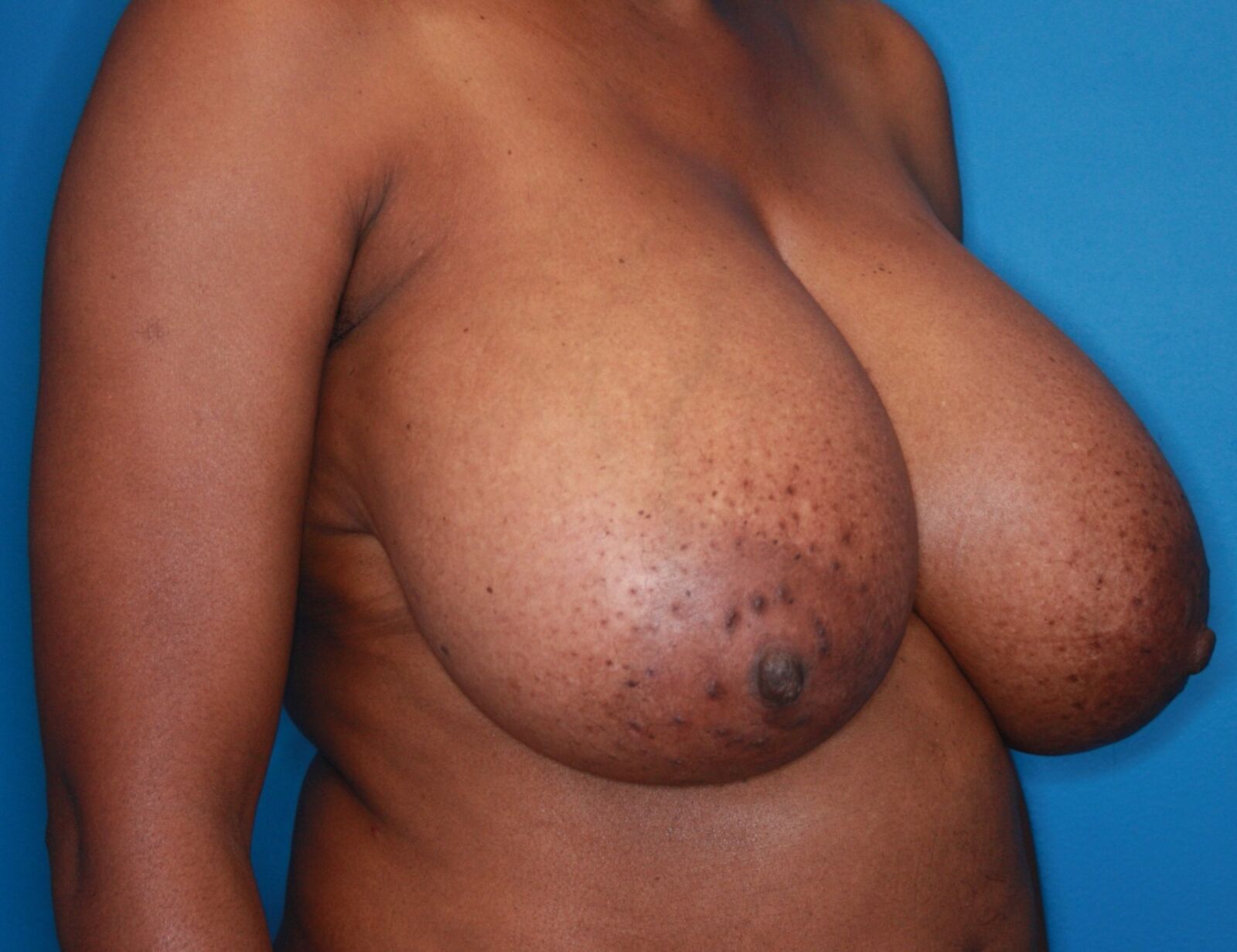 Pre Op Breast Reduction Collection 11