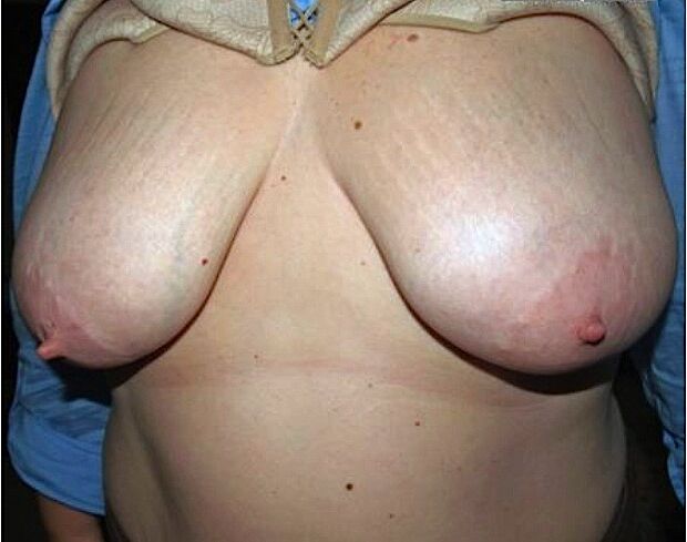 Some saggy tits with stretch marks