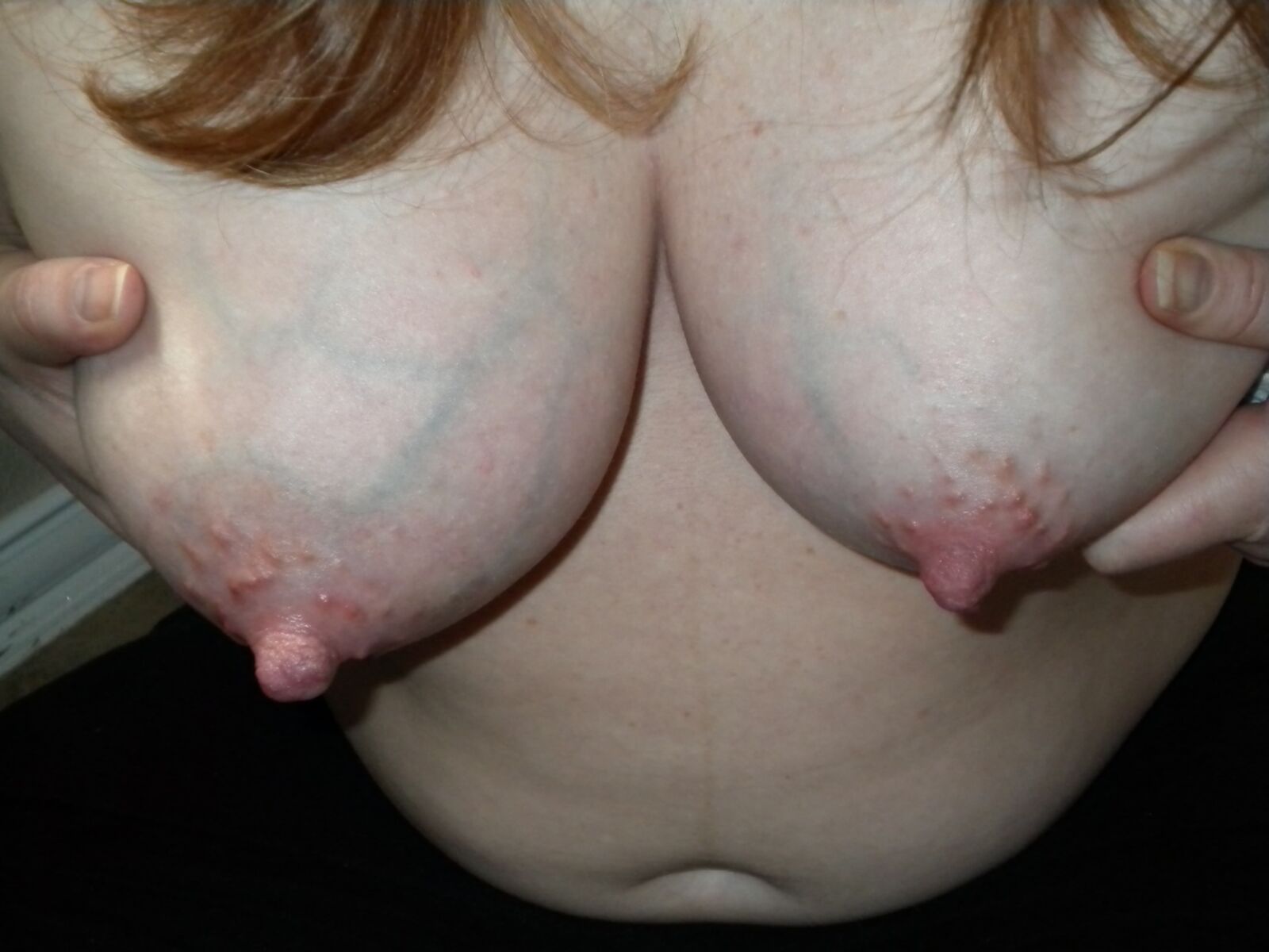 Veins visible on tits