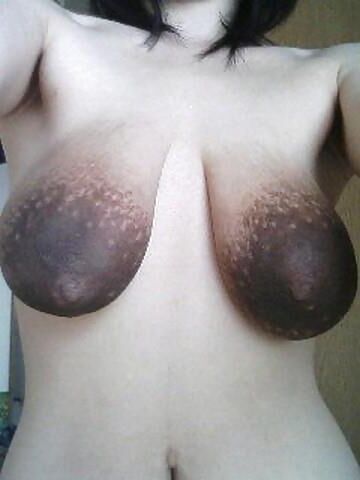 Massive dark areolas