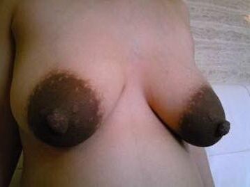 Massive dark areolas