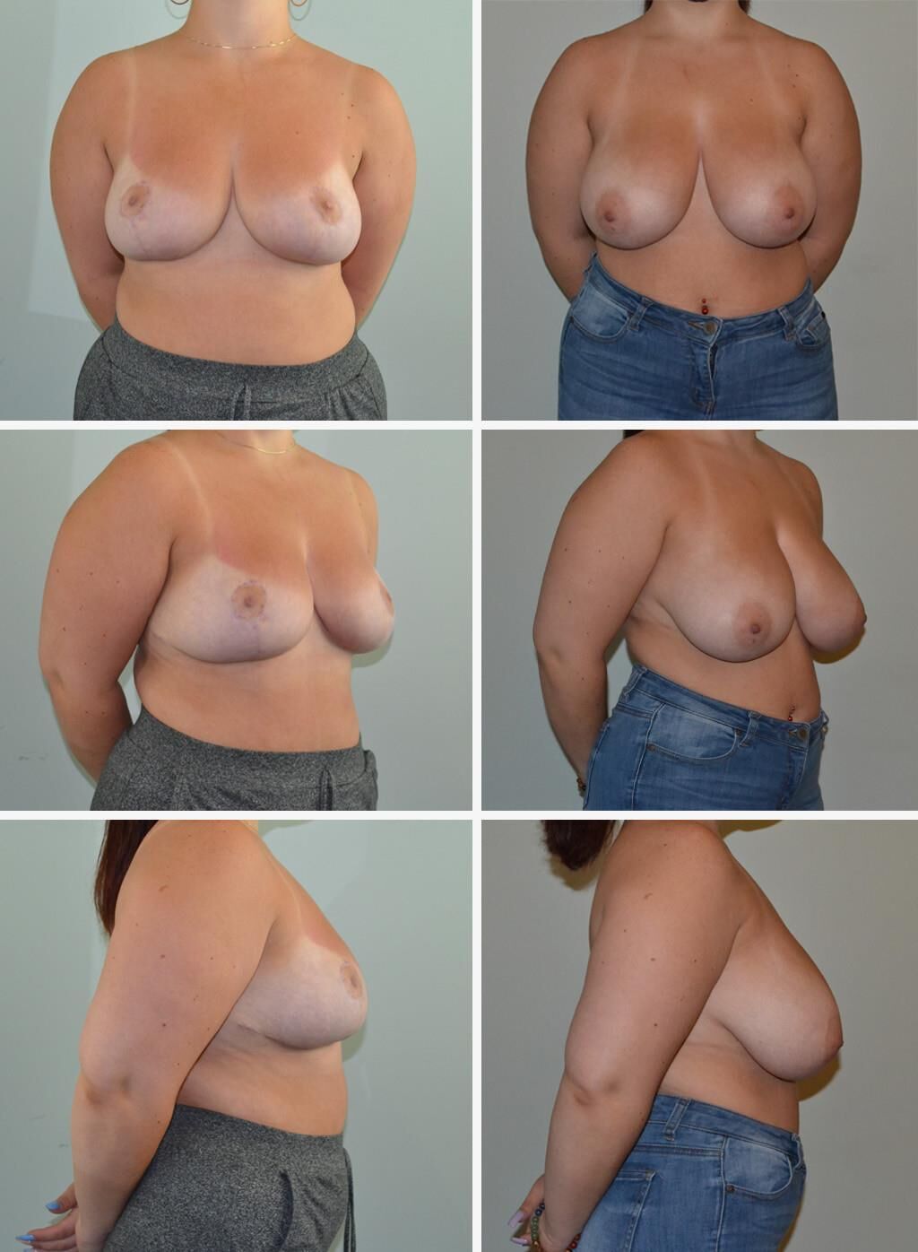 Pre surgery 