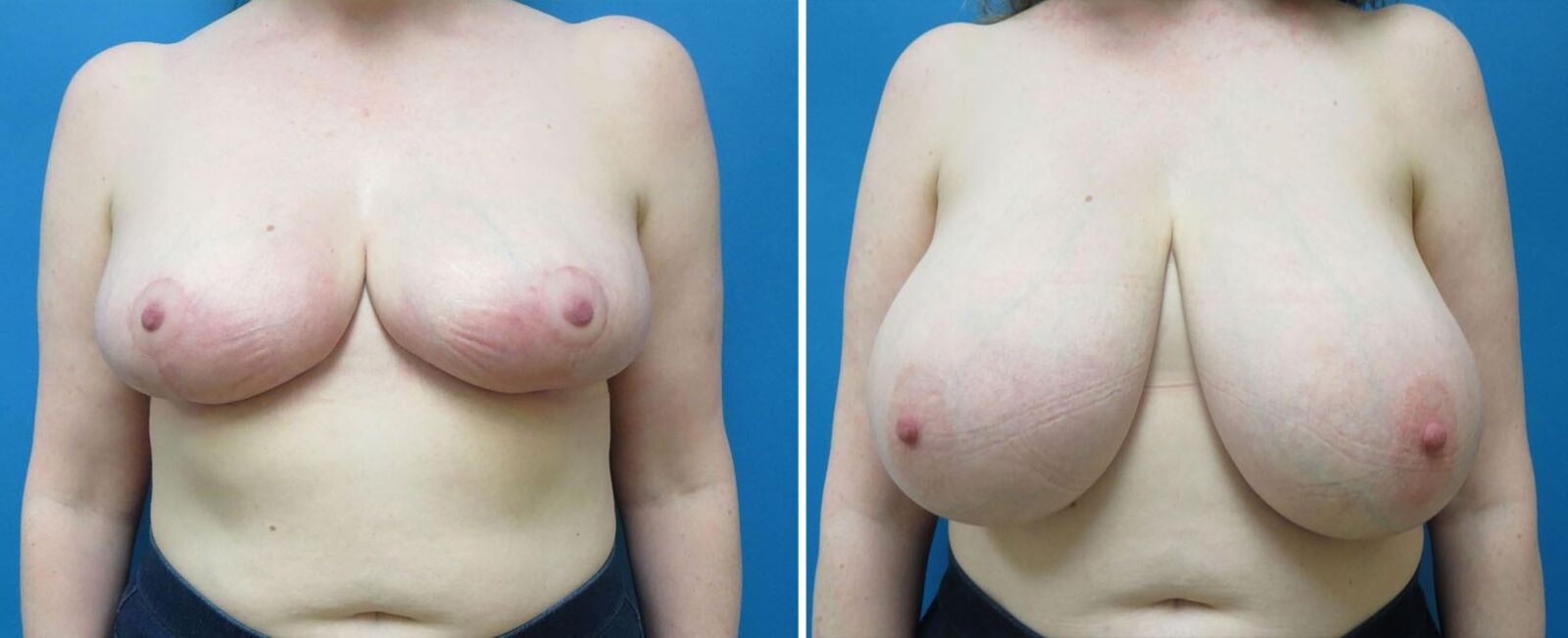 Pre surgery 
