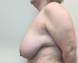 Pre surgery 