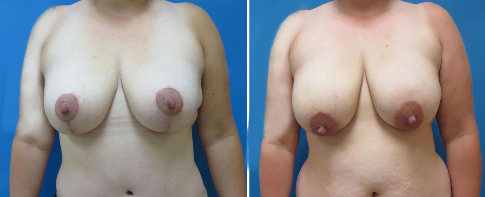 Pre surgery 