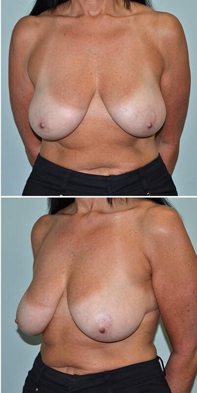 Pre surgery 