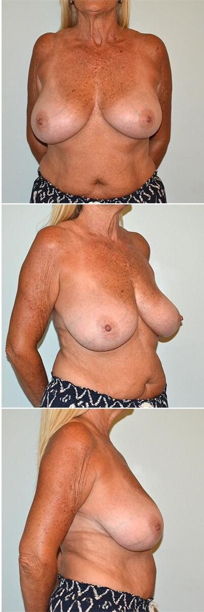 Pre surgery 