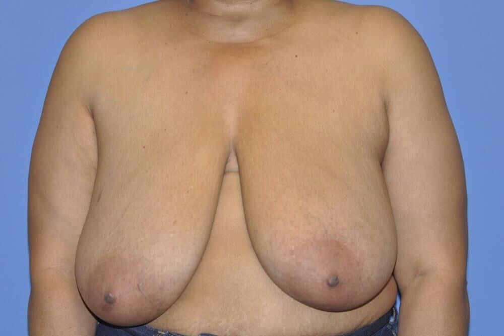 Pre surgery 