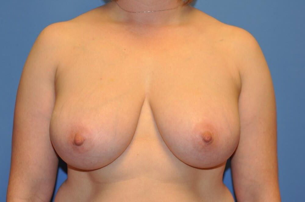 Pre surgery 