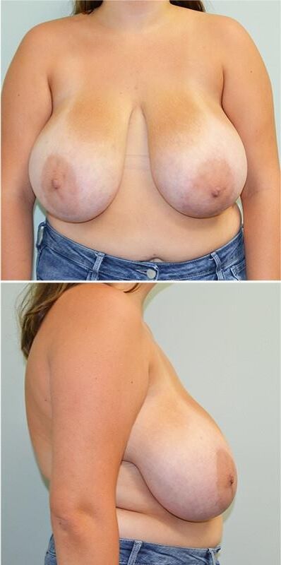 Pre surgery 