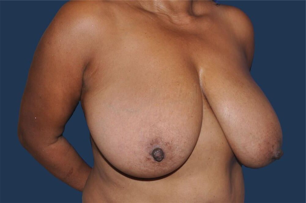 Pre surgery Black titties 