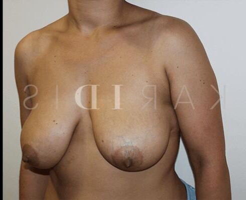 Pre surgery Black titties 