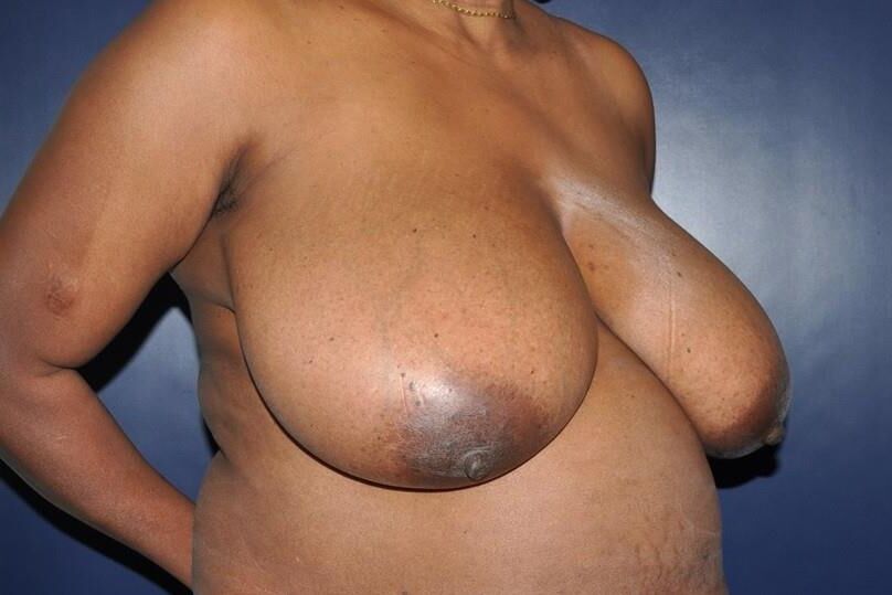 Pre surgery Black titties 