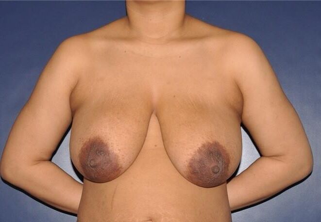 Pre surgery Black titties 