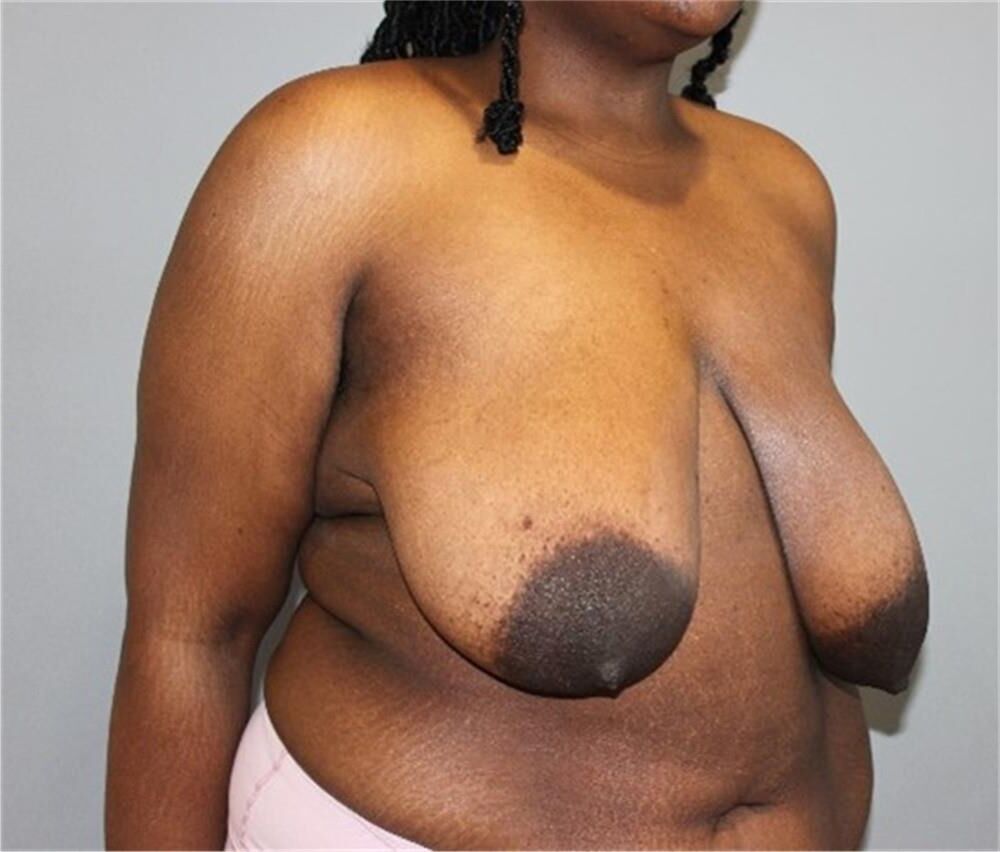 Pre surgery Black titties 