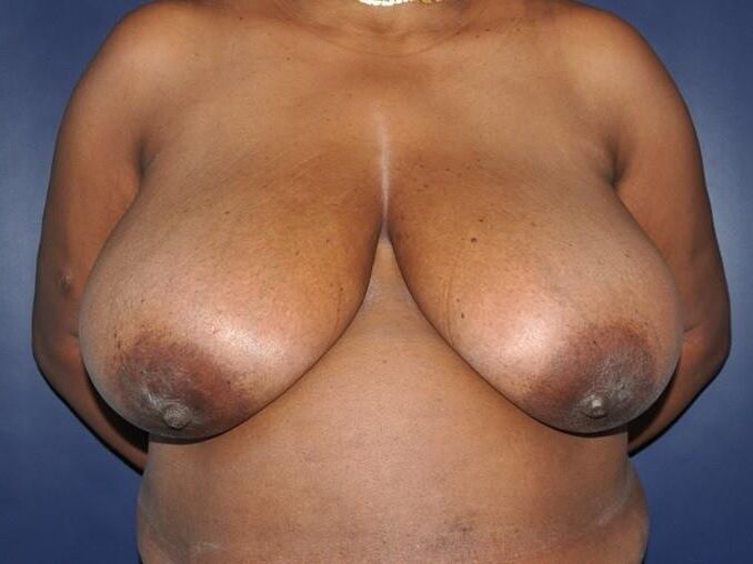 Pre surgery Black titties 