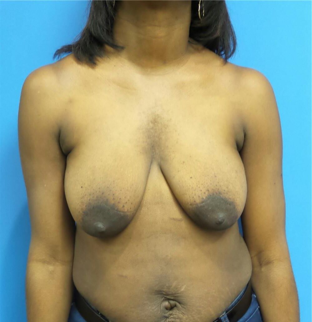 Pre surgery Black titties 