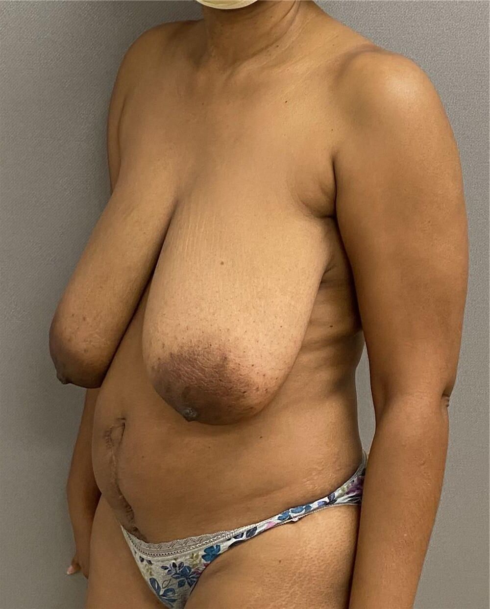 Pre surgery Black titties 