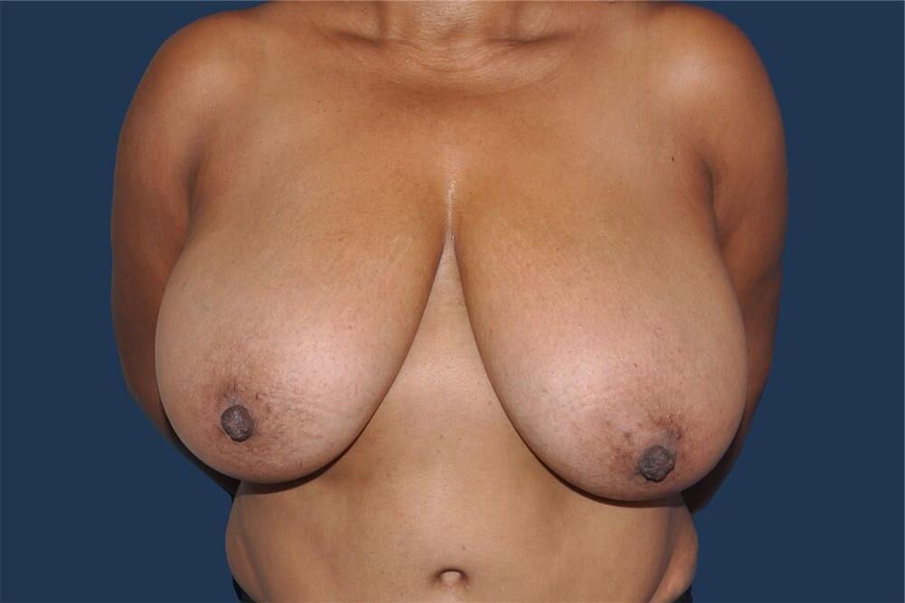 Pre surgery Black titties 