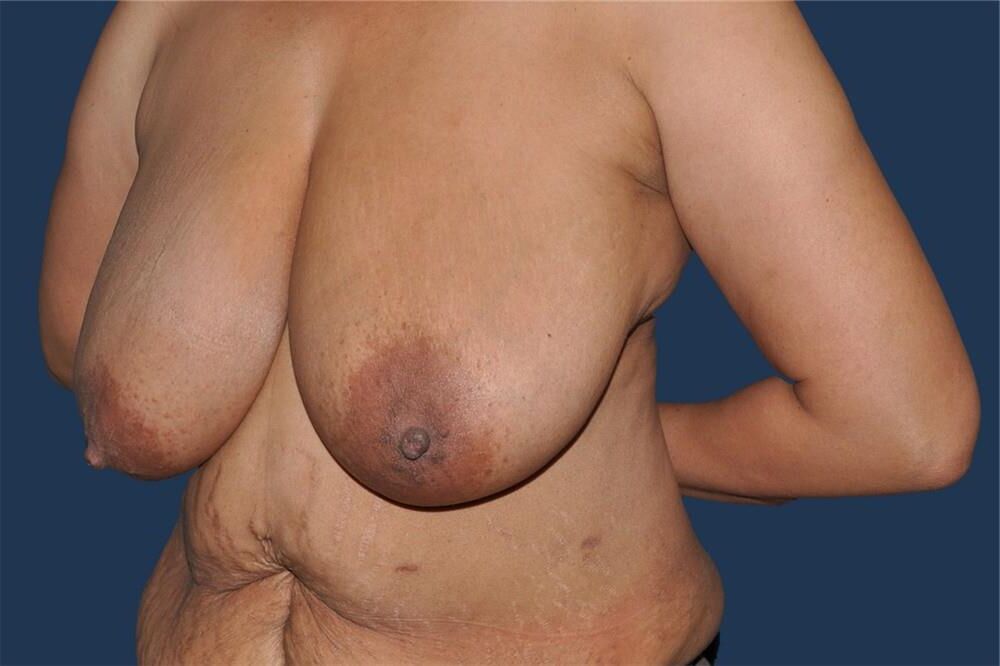 Pre surgery Black titties 