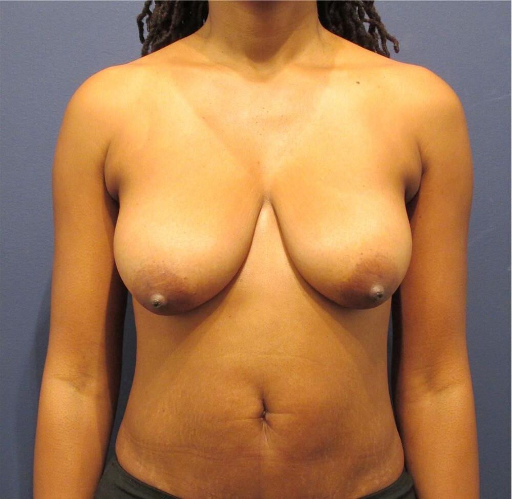 Pre surgery Black titties 