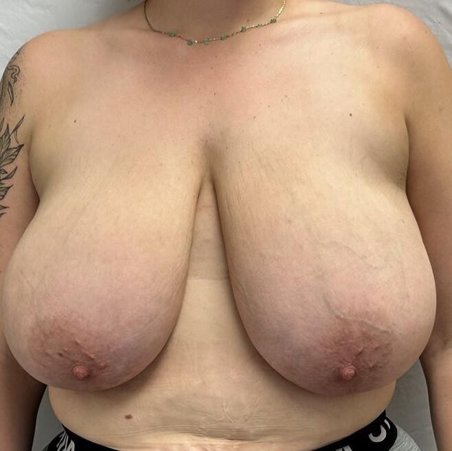 Pre surgery Black titties 