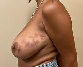 Pre surgery Black titties 