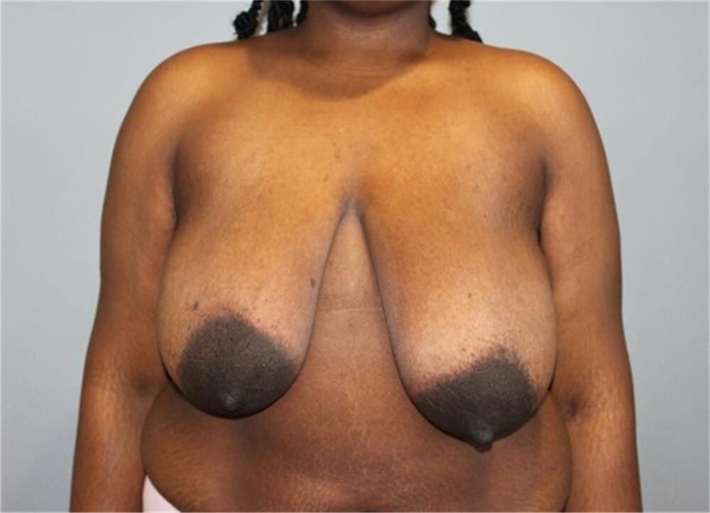Pre surgery Black titties 