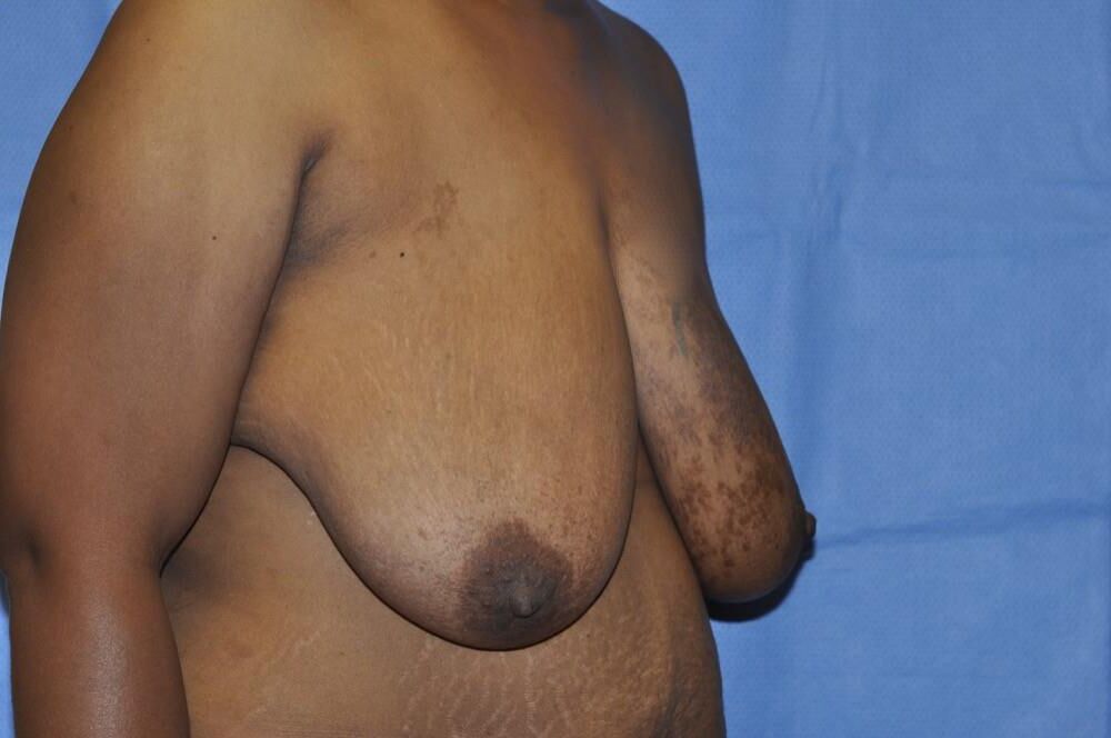 Pre surgery Black titties 