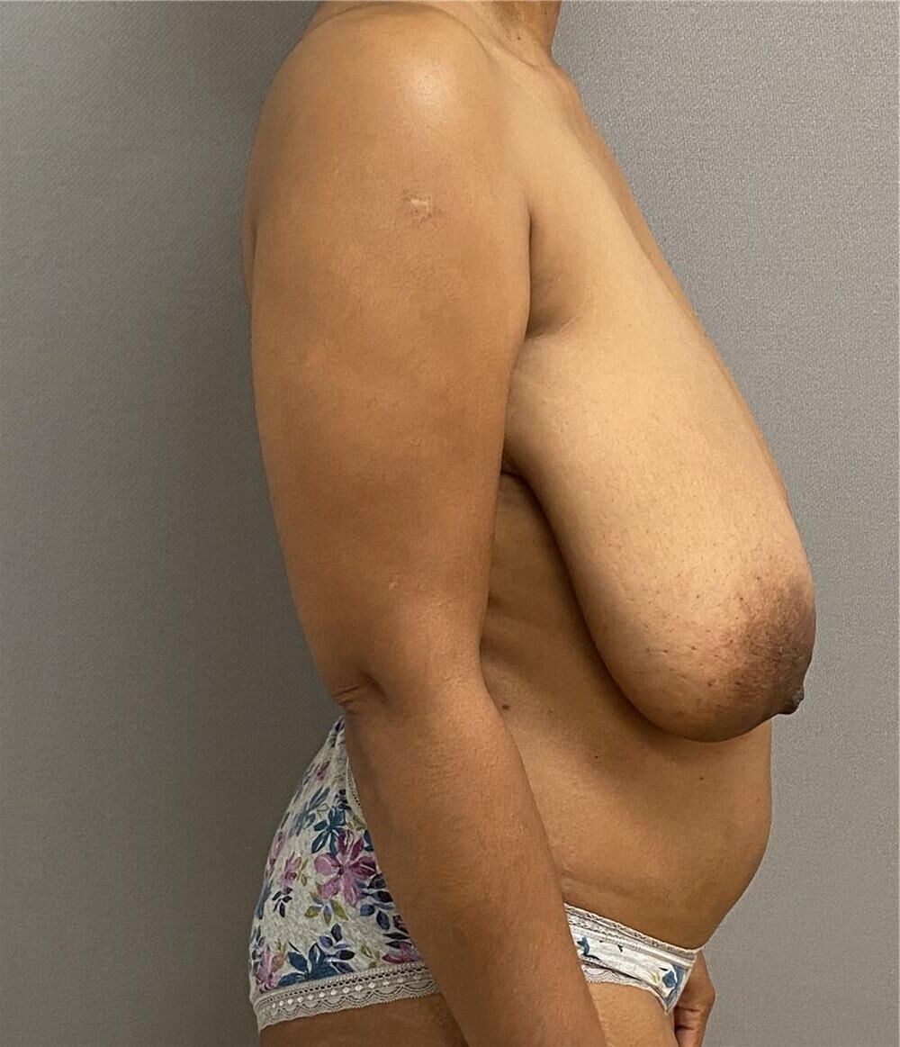 Pre surgery Black titties 