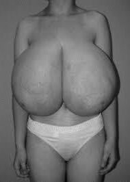 I Love Woman with macromastia 
