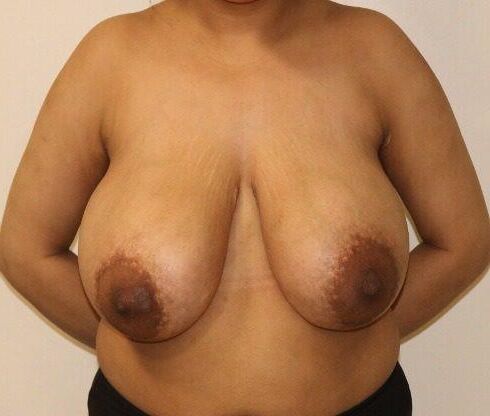 Pre surgery Black titties 