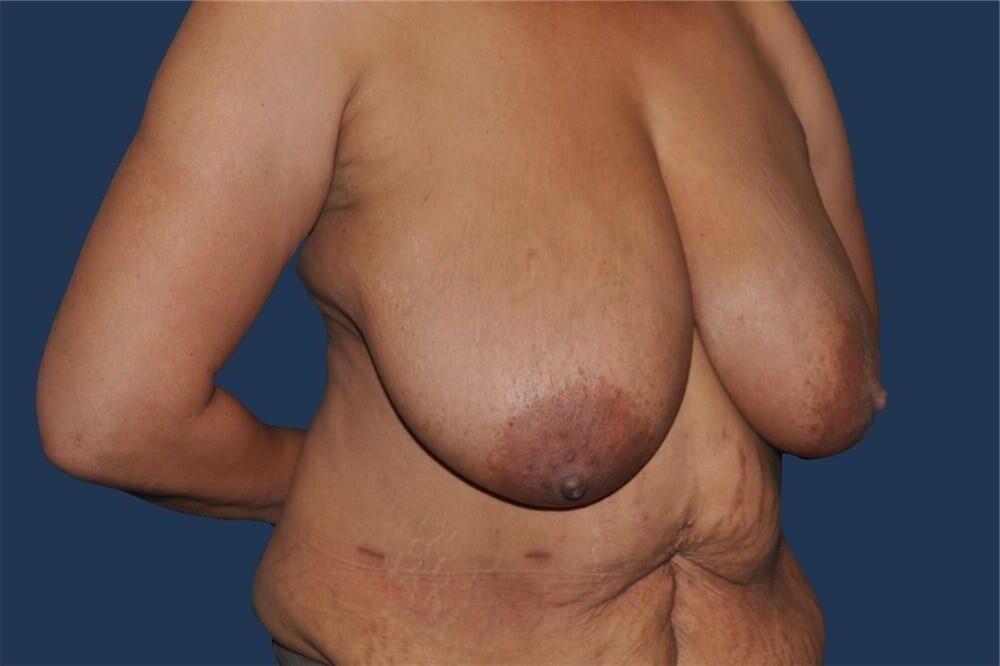 Pre surgery Black titties 