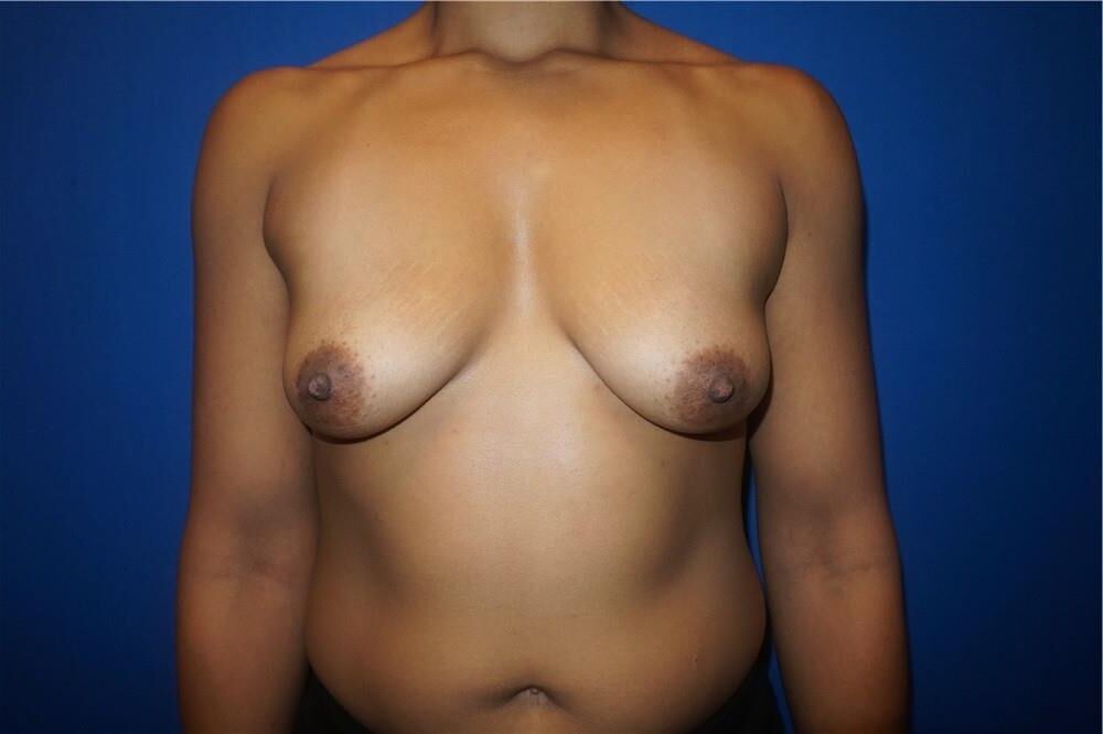 Pre surgery Black titties 