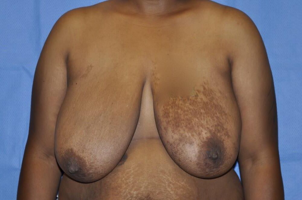 Pre surgery Black titties 