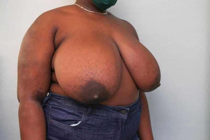 Pre surgery Black titties 