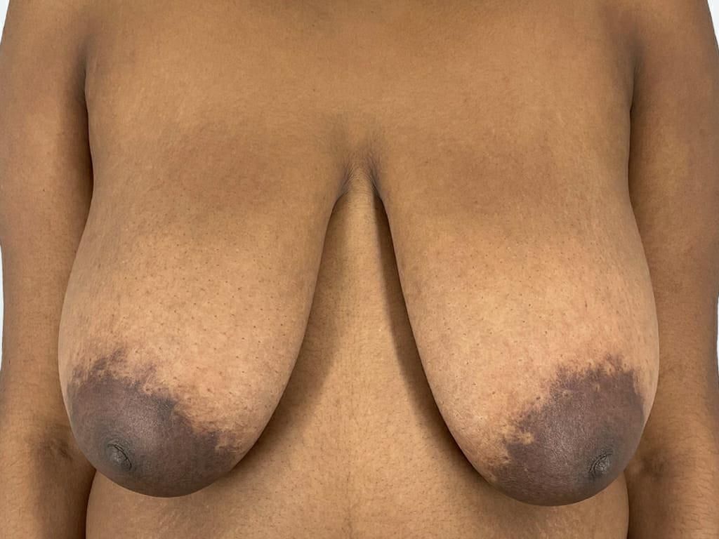 Pre surgery Black titties 