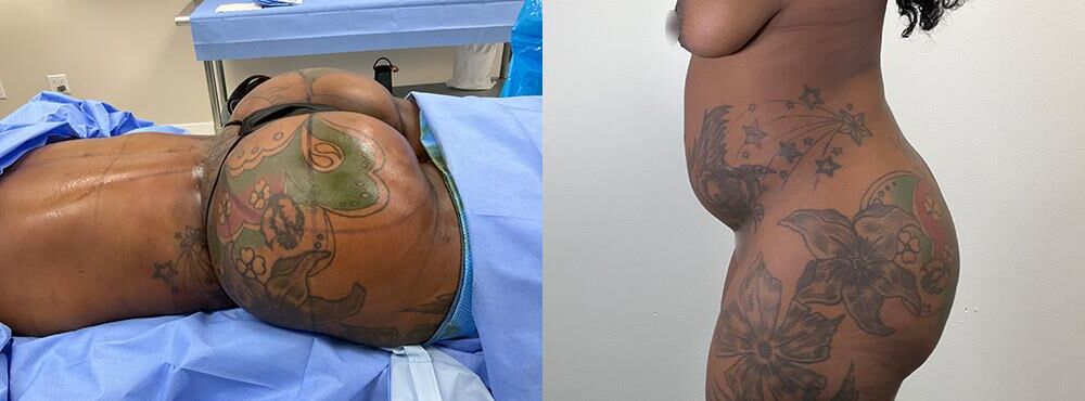 Pre surgery Black titties 