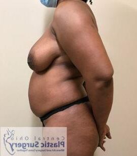 Pre surgery Black titties 