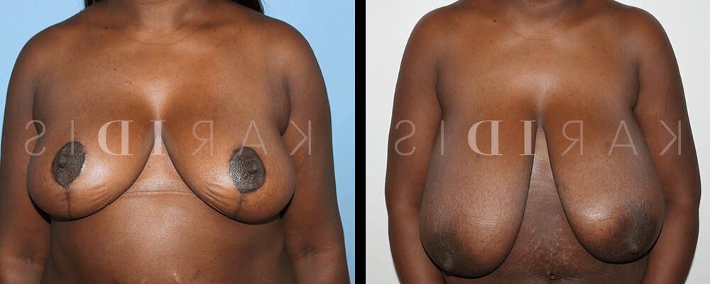 Pre surgery Black titties 