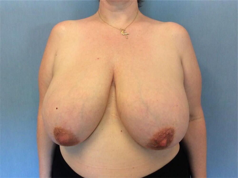Pre surgery 