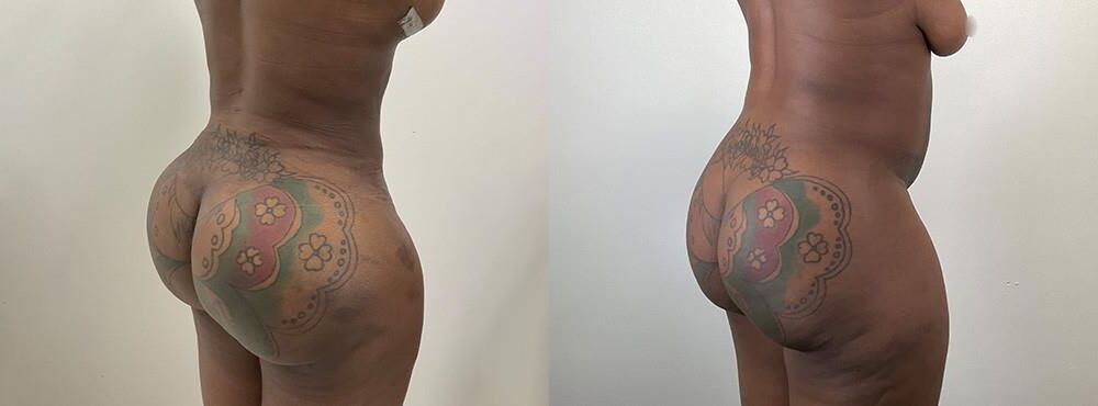 Pre surgery Black titties 