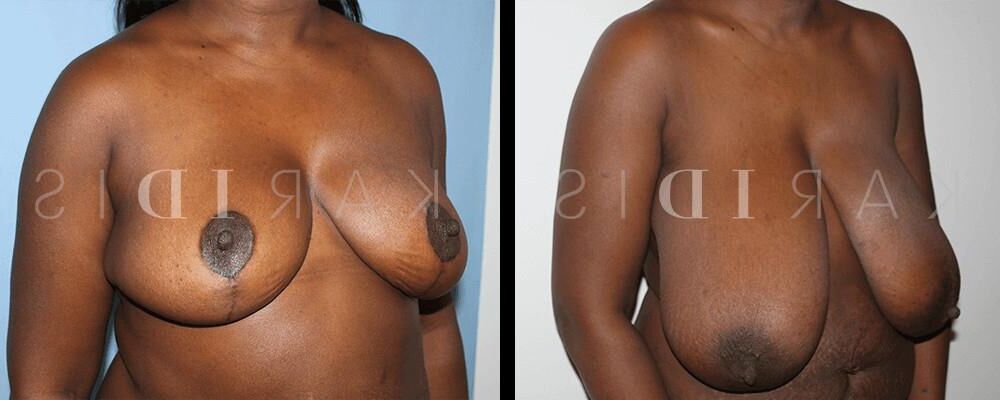 Pre surgery Black titties 
