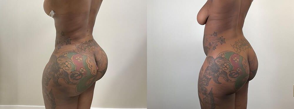 Pre surgery Black titties 