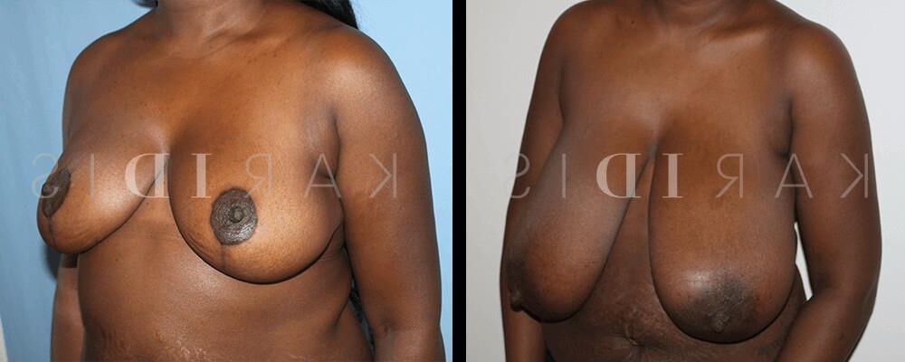 Pre surgery Black titties 