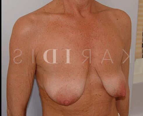 Pre surgery 