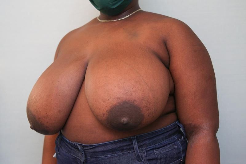 Pre surgery Black titties 